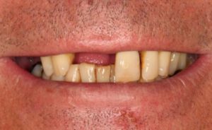 Implantologie Fall 2 vorher