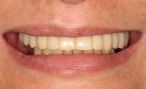 Implantologie Fall 3 nachher