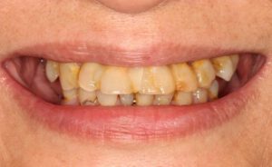 Implantologie Fall 3 vorher