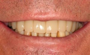 Implantologie Fall 4 nachher