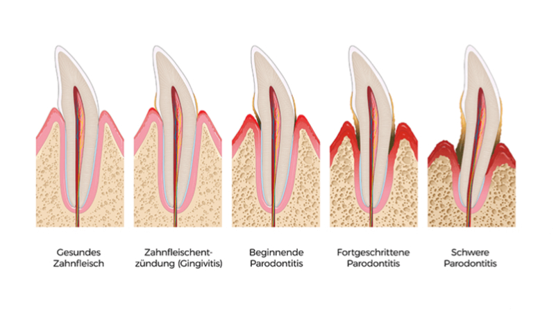 verlauf-einer-parodontitis