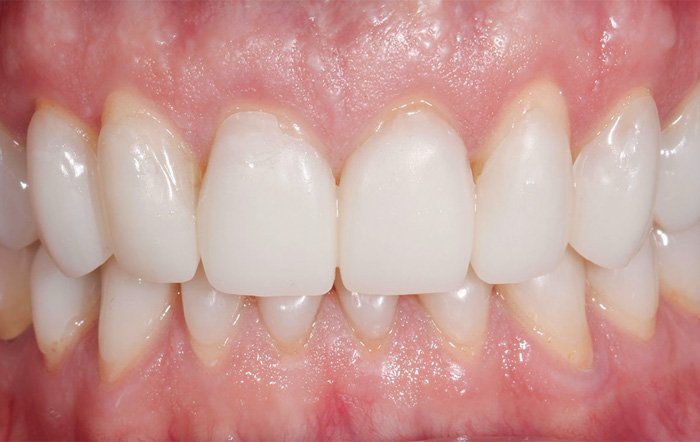 Behandlungsschritt Vollkeramik-Krone Dr. Vogtner