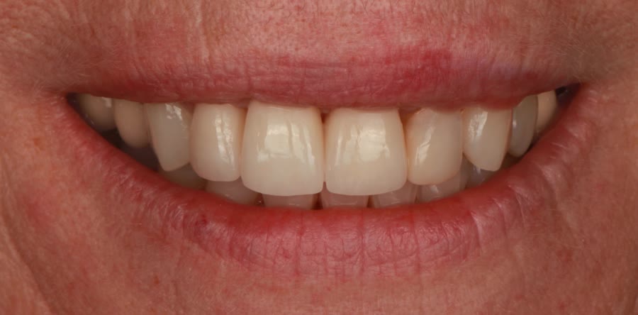 Nachher: Frontzähne nach der Behandlung