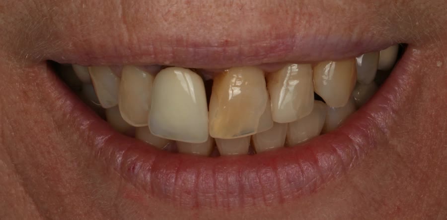 Vorher: Frontzähne vor der Behandlung