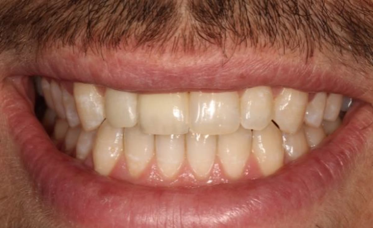 Nachher: Sofortimplantat nach Unfall